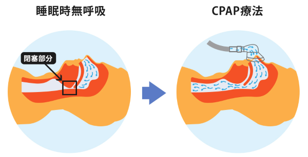 睡眠時無呼吸→CPAP療法