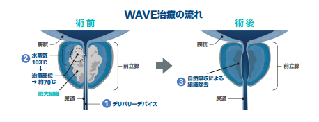 WAVE治療の流れ